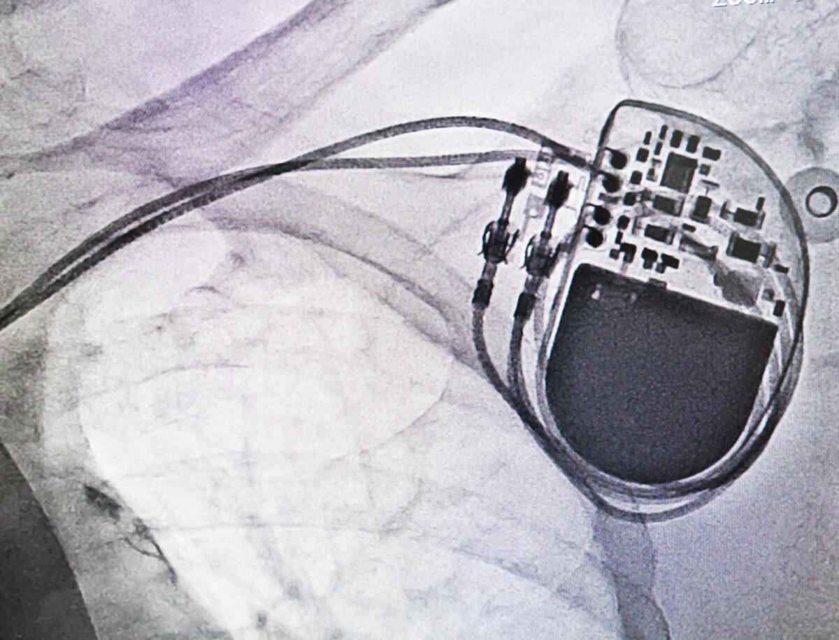 Pacemaker and TENS Unit Use Is it Safe? Roots of Being